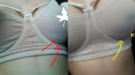 做了自体脂肪隆胸 我也拥有了很辣的身材