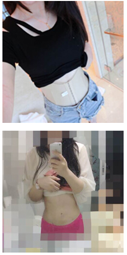 做了腰部吸脂 有图有真相！！！