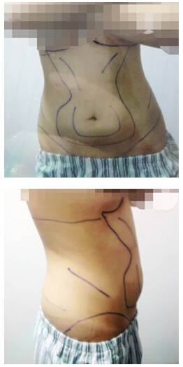 做了腰部吸脂 有图有真相！！！