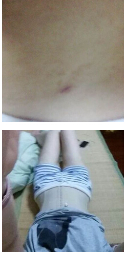 做了腰部吸脂 有图有真相！！！