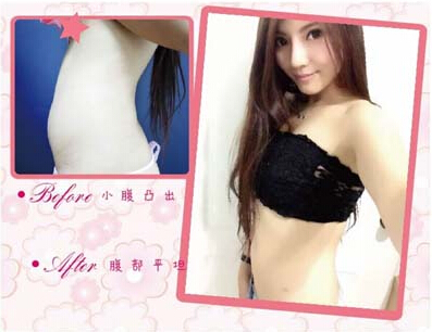 腰腹吸脂 让我告别海马腰