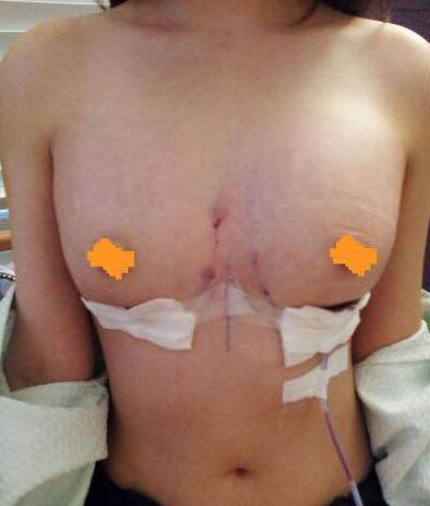 做了自体脂肪隆胸 魅力又回来了！