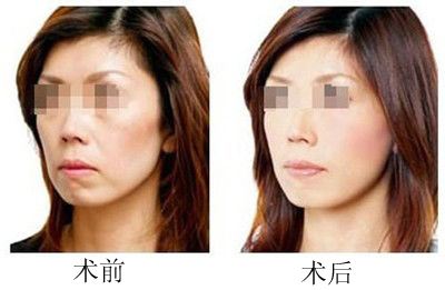 厦门做拉皮除皱大概需要多少钱