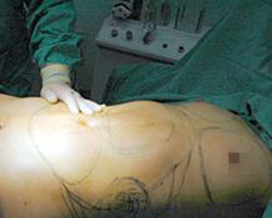 我在北京艺星医疗美容医院自体脂肪隆胸真实经历