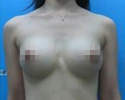 我在北京艺星医疗美容医院自体脂肪隆胸真实经历