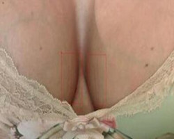 我在北京艺星医疗美容医院自体脂肪隆胸真实经历