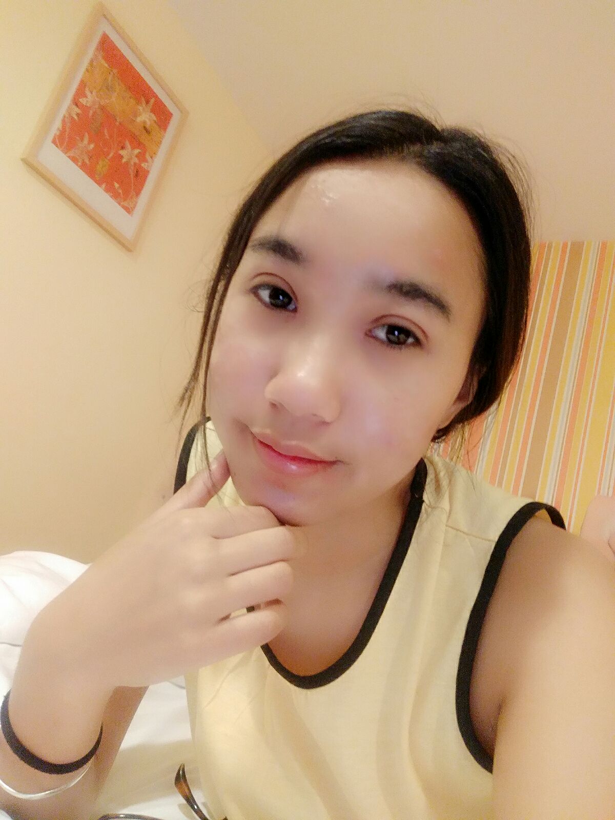 8.15号割的双眼皮 感谢慕医生