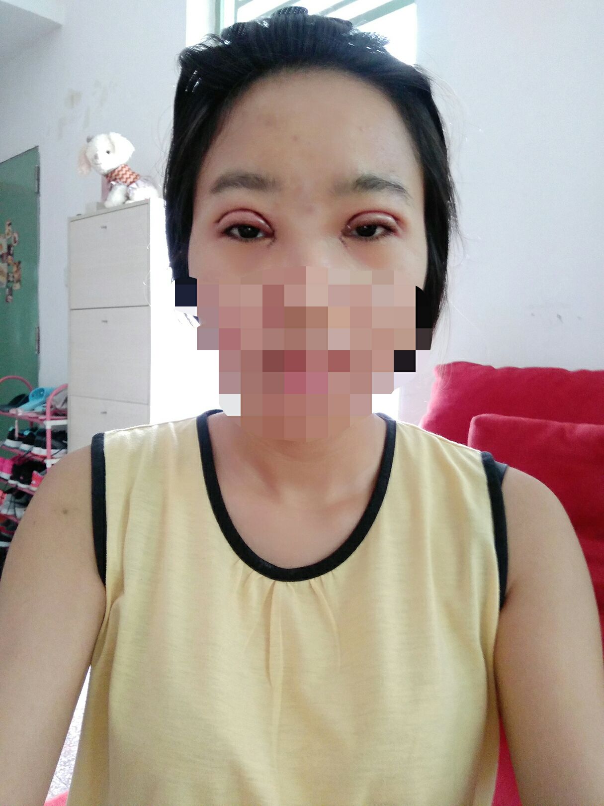 8.15号割的双眼皮 感谢慕医生