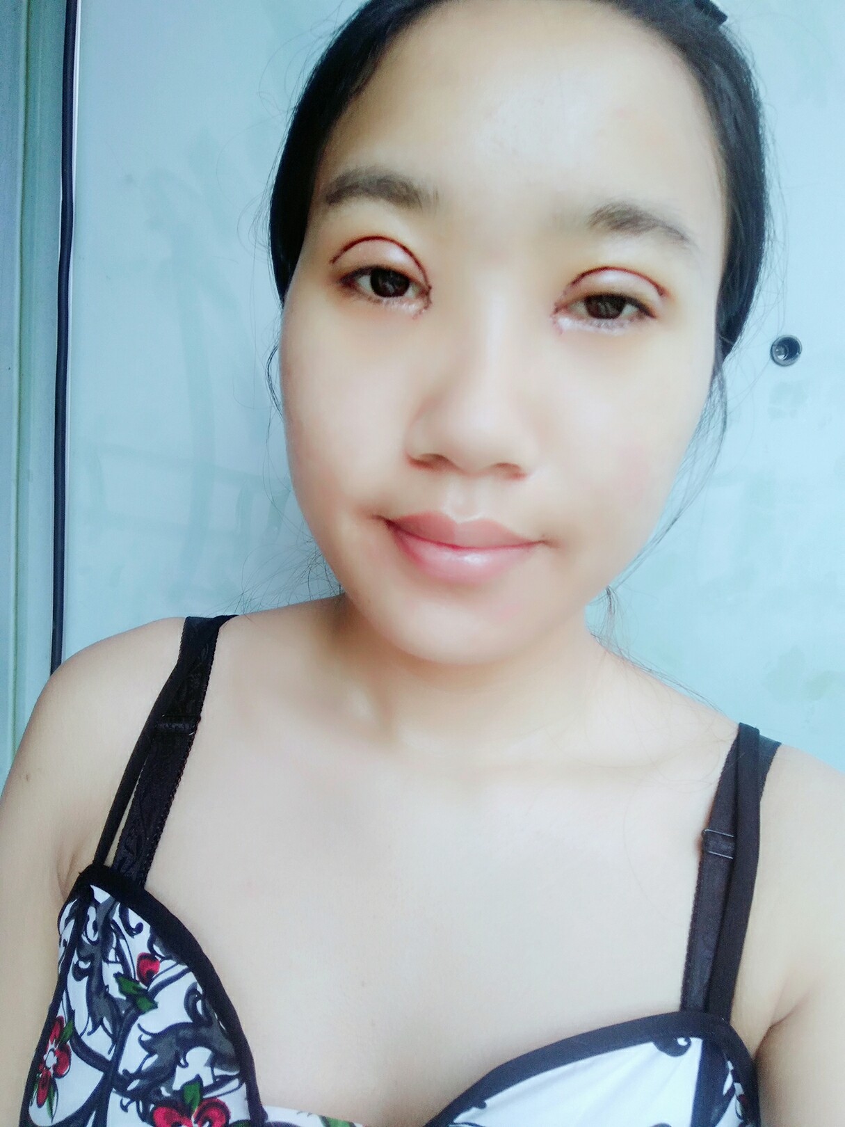 8.15号割的双眼皮 感谢慕医生