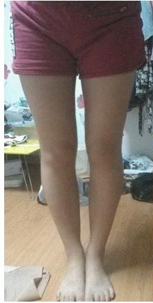 大腿吸脂三个月 瘦了很多