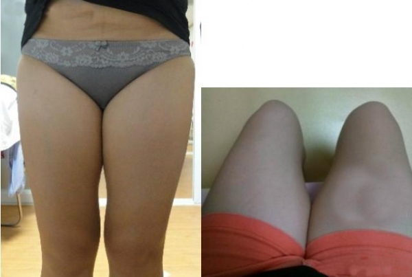 大腿吸脂三个月 瘦了很多