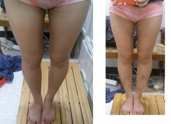 大腿吸脂三个月 瘦了很多