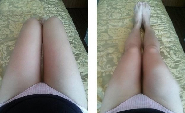 大腿吸脂三个月 瘦了很多