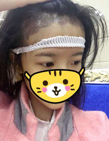 成都玉之光发际线种植 果不错~