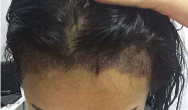 成都玉之光发际线种植 果不错~