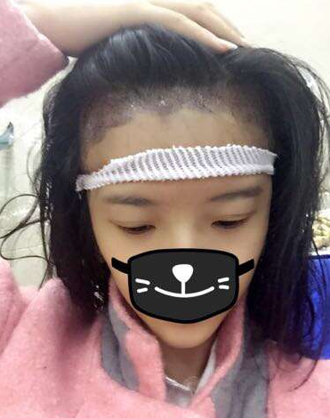 成都玉之光发际线种植 果不错~