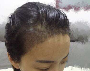 成都玉之光发际线种植 果不错~