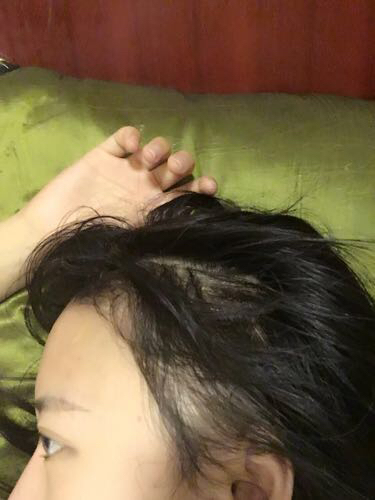 成都玉之光头发移植 果杠杠的~