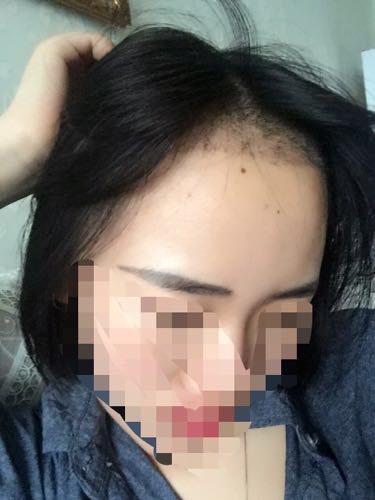 成都玉之光头发移植 果杠杠的~