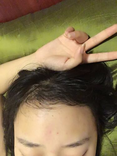 成都玉之光头发移植 果杠杠的~