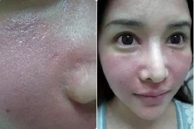 成都玉之光激光嫩肤经历 爱美的MM一定要看