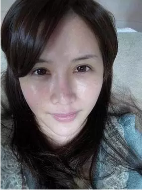 成都玉之光激光嫩肤经历 爱美的MM一定要看