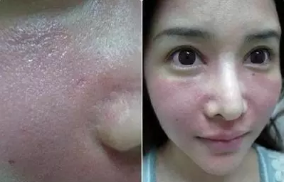 成都玉之光激光嫩肤经历 爱美的MM一定要看