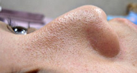 成都玉之光做了杏仁酸换肤 皮肤真的净白无瑕了