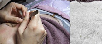 成都玉之光做了杏仁酸换肤 皮肤真的净白无瑕了