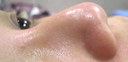 成都玉之光做了杏仁酸换肤 皮肤真的净白无瑕了