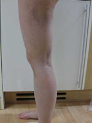 北京禾美嘉大腿吸脂 给大家分享一下体验