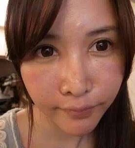 成都玉之光激光嫩肤经历 爱美的MM一定要看