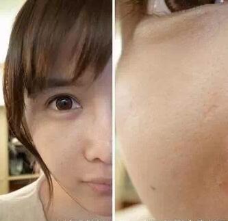 成都玉之光激光嫩肤经历 爱美的MM一定要看