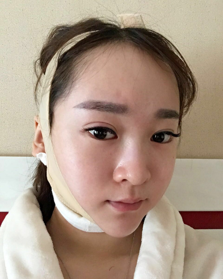 吸脂去除双下巴案例分享和前后对比照