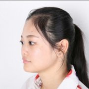 自体脂肪隆鼻术后恢复全过程对比照曝光