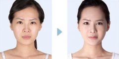 厦门自体软骨隆鼻手术多少钱 适应什么人群