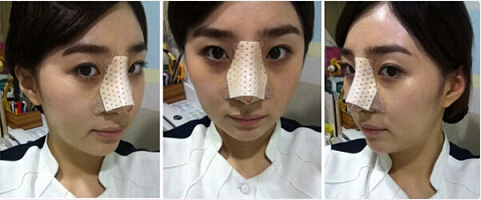 深圳希思崔院长隆鼻整形 摆脱了猪妹妹的称号