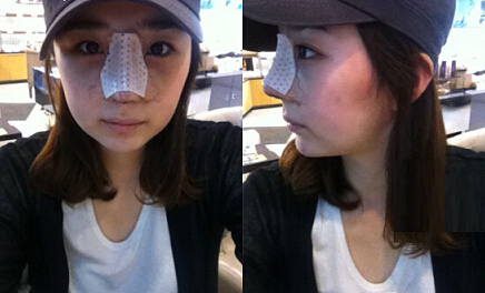 深圳希思崔院长隆鼻整形 摆脱了猪妹妹的称号