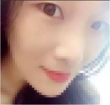 深圳希思做的双眼皮 现在美美的