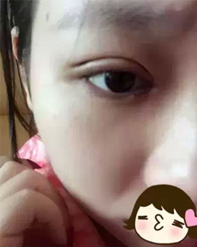 深圳希思做的双眼皮+开眼角 感谢杨医师！