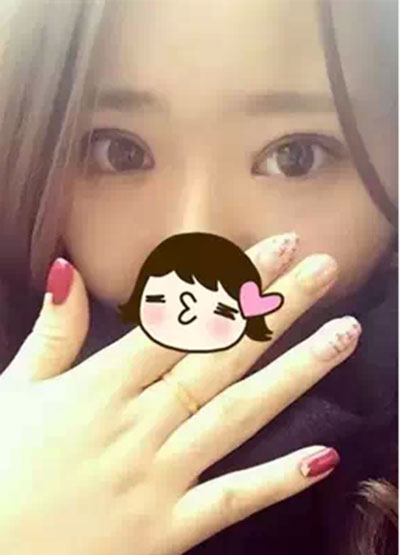 深圳希思做的双眼皮+开眼角 感谢杨医师！