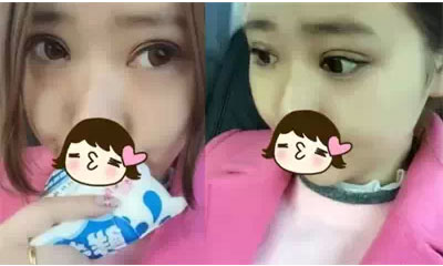 深圳希思做的双眼皮+开眼角 感谢杨医师！