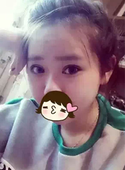 深圳希思做的双眼皮+开眼角 感谢杨医师！