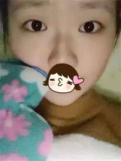 深圳希思做的双眼皮+开眼角 感谢杨医师！