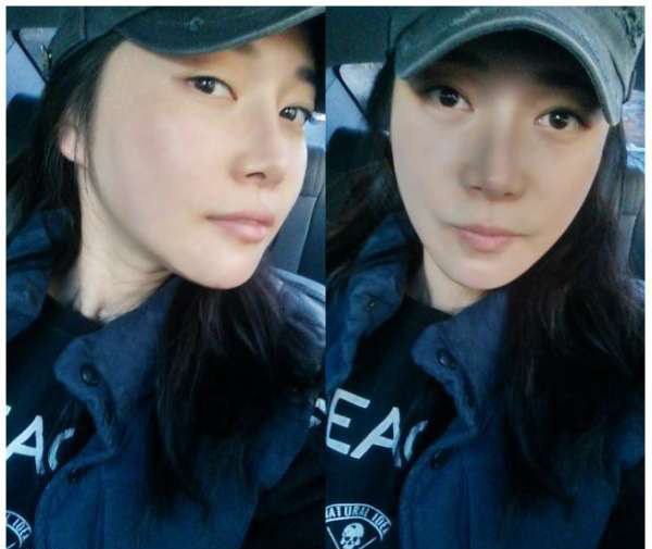 柳大烈给我做的改脸型手术 求围观！