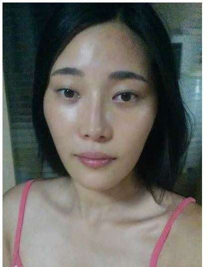 柳大烈给我做的改脸型手术 求围观！