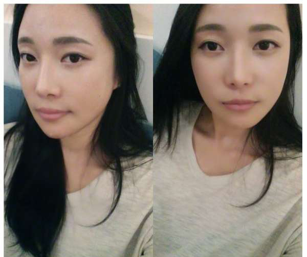 柳大烈给我做的改脸型手术 求围观！