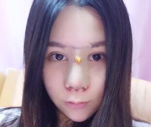 　　以前做过鼻子，但是不好看，山根那个地方太奇怪了，形状不太协调，听说赵士俊医生做鼻子修复很好，就慕名而来啦，放心的把自己的鼻子交给他，后来的果没有让我失望哦。    　　之前做的鼻子，奇怪吧。    　　做了手术之后打了消炎针，漏掉一天没搭，伤口就发红泛肿了，简直吓人，赶紧去医院打消炎，喝白粥度日。    　　没拆纱布，不过感觉已经听好了，拆了应该很好看的。    　　恢复得不错了，穿了古装，画了个美美的妆，完全没有违和感。