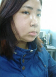 在北京炫美磨了下颌角 恢复纪实分享