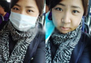 在北京炫美磨了下颌角 恢复纪实分享